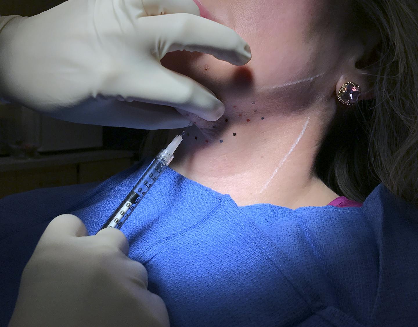 Edina plastic surgeon Jess Prischmann injected a patient with Kybella, an FDA-approved synthetic version of deoxycholic acid that dissolves fat under the chin. Photos provided by Aimee.Blanchette