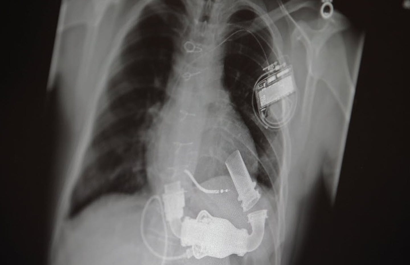 A heart pump like this one ran out of power, and the resident of an Eden Prairie care facility died that night.