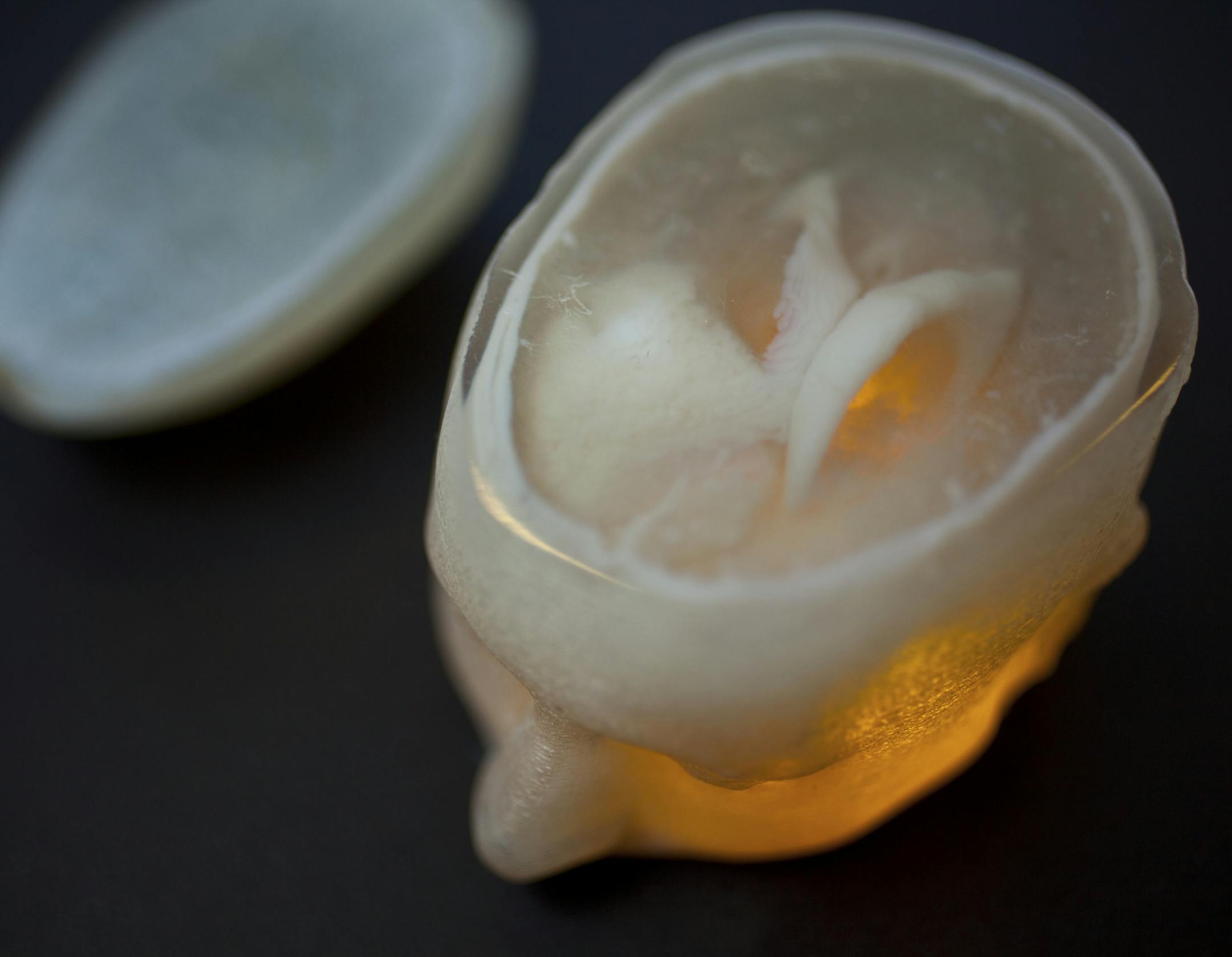 A 3-D print of Steven Keating’s MRI data showing his large brain tumor, the white mass in the right front section of the brain, in Cambridge, Mass., March 6, 2015. The case of Keating, who collected and researched his own patient data, points to what medical experts say could be gained if patients had full and easier access to their medical information. (Erik Jacobs/The New York Times)