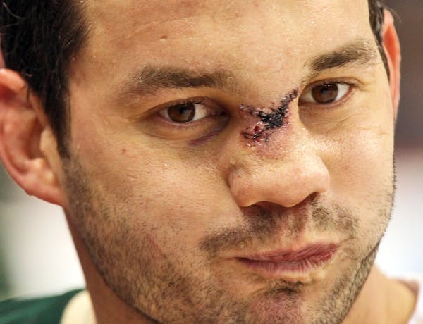 The Wild's Zenon Konopka needed 30 stitches across the bridge of his nose after getting hit by a high stick on Saturday's season opener against Colora