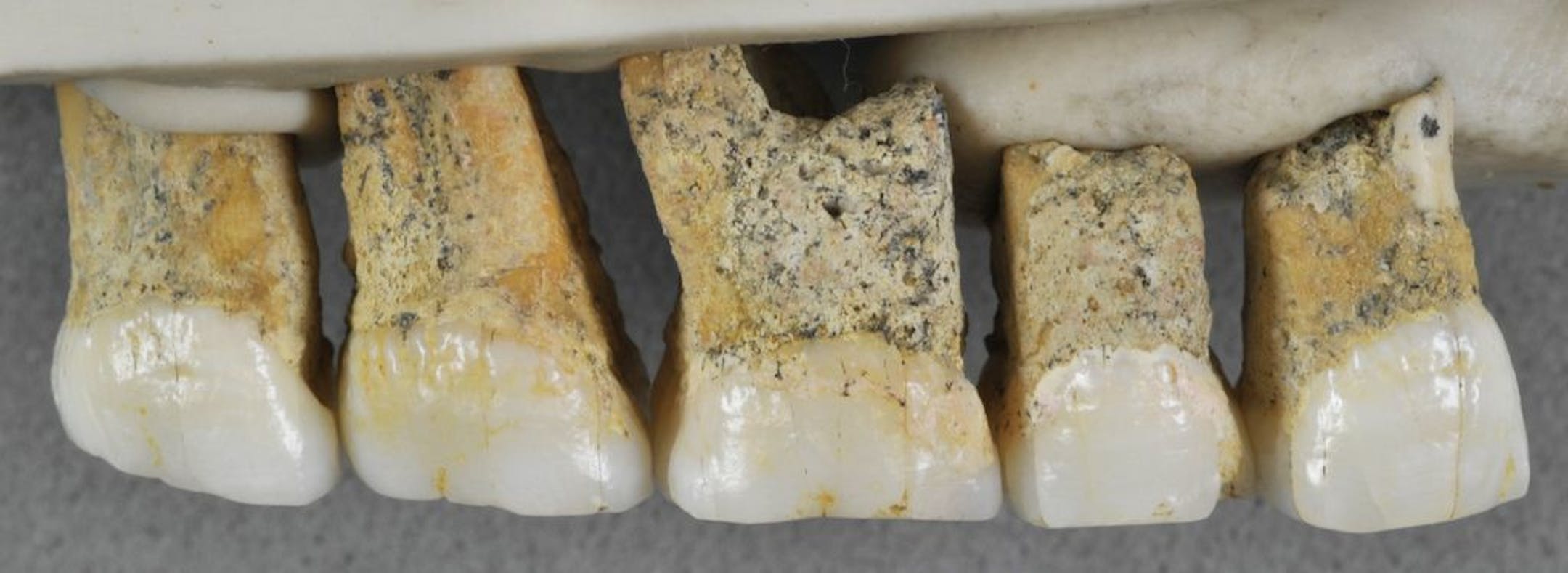 This undated photo provided by the Callao Cave Archaeology Project in April 2019 shows the right upper teeth of the individual CCH6 of the newly discovered species Homo luzonensis. From left are two premolars and 3 molars. In a study released on Thursday, April 10, 2019, scientists report that tests on two samples from the species show minimum ages of 50,000 years and 67,000 years.