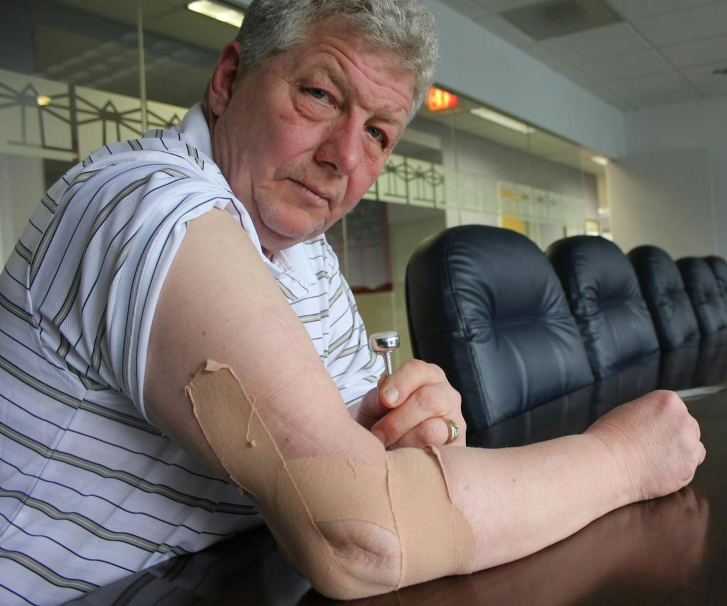 Minnesota resident Steven Baker says the FDA-approved prosthetic elbow implanted in his arm has never worked properly and continues to cause excruciating pain. Records show that the part of the prosthesis that malfunctioned in Baker's arm had been the subject of two recalls in Canada and an "adverse event report" of the U.S. Food and Drug Administration.