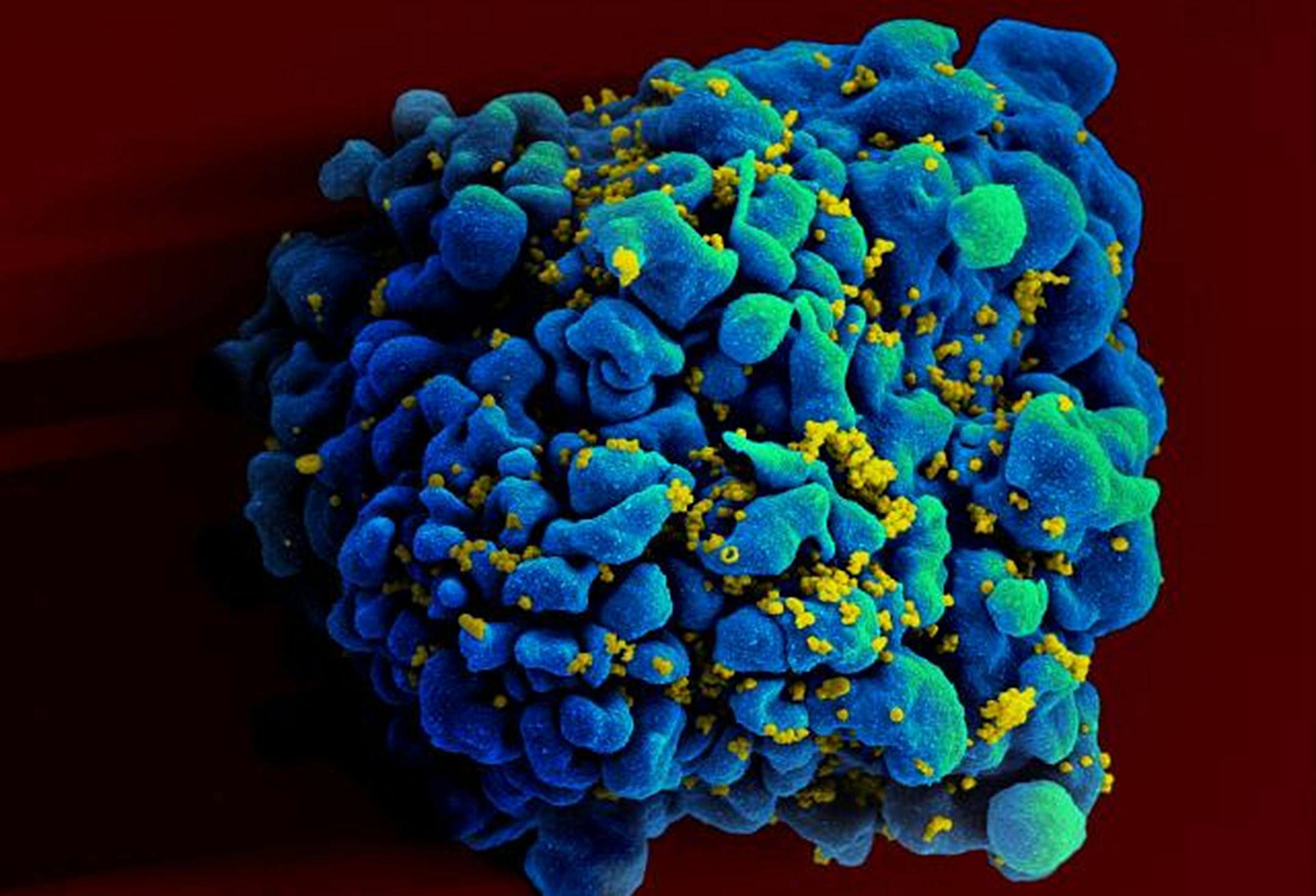FILE - This April 12, 2011 electron microscope image made available by the National Institute of Allergy and Infectious Diseases shows an H9 T cell, blue, infected with the human immunodeficiency virus (HIV), yellow. Research suggests that a shot every one to three months may someday give an alternative to the daily pills that some people take now to cut their risk of getting HIV from sex with an infected partner. An experimental drug given in periodic shots completely protected monkeys from inf
