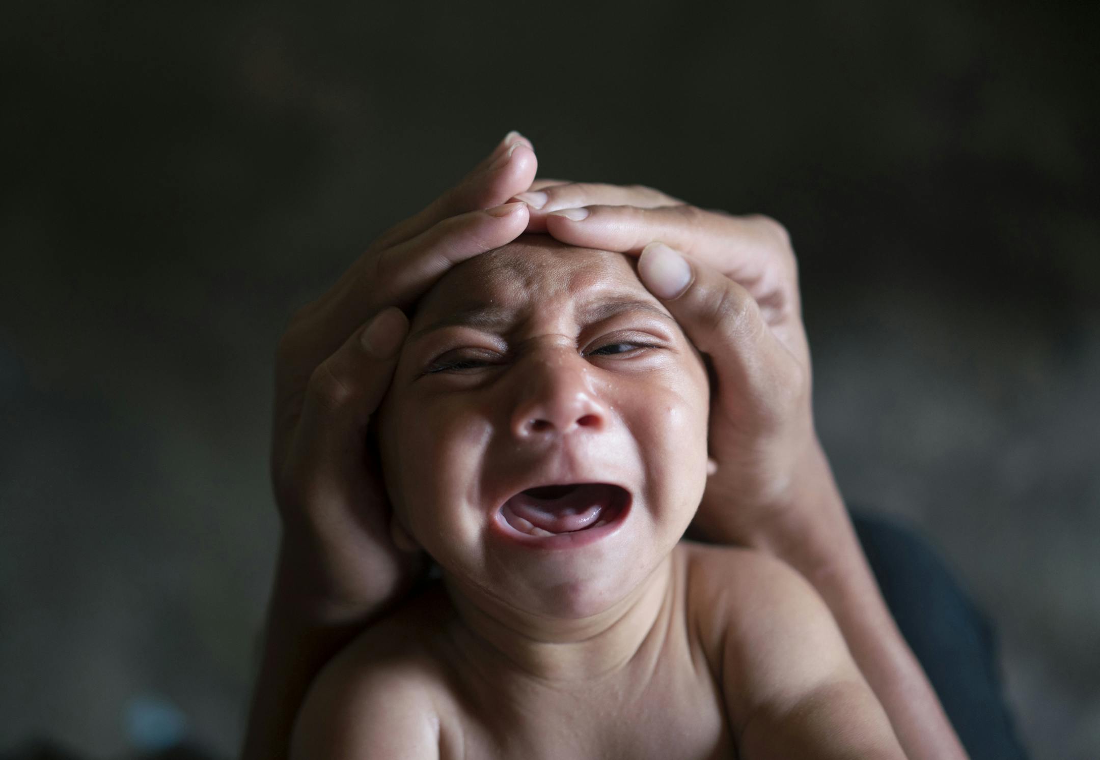FILE - In this Jan. 30, 2016 file photo, Jose Wesley, who was born with microcephaly and screams uncontrollably for long stretches, is attended to in Bonito, Pernambuco state, Brazil. The Zika virus is drawing worldwide attention to a devastating birth defect that until now has gotten little public notice. Regardless of whether the mosquito-borne virus really causes babies to be born with abnormally small heads, a variety of other conditions can trigger it. (AP Photo/Felipe Dana, File)
