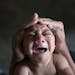 FILE - In this Jan. 30, 2016 file photo, Jose Wesley, who was born with microcephaly and screams uncontrollably for long stretches, is attended to in 
