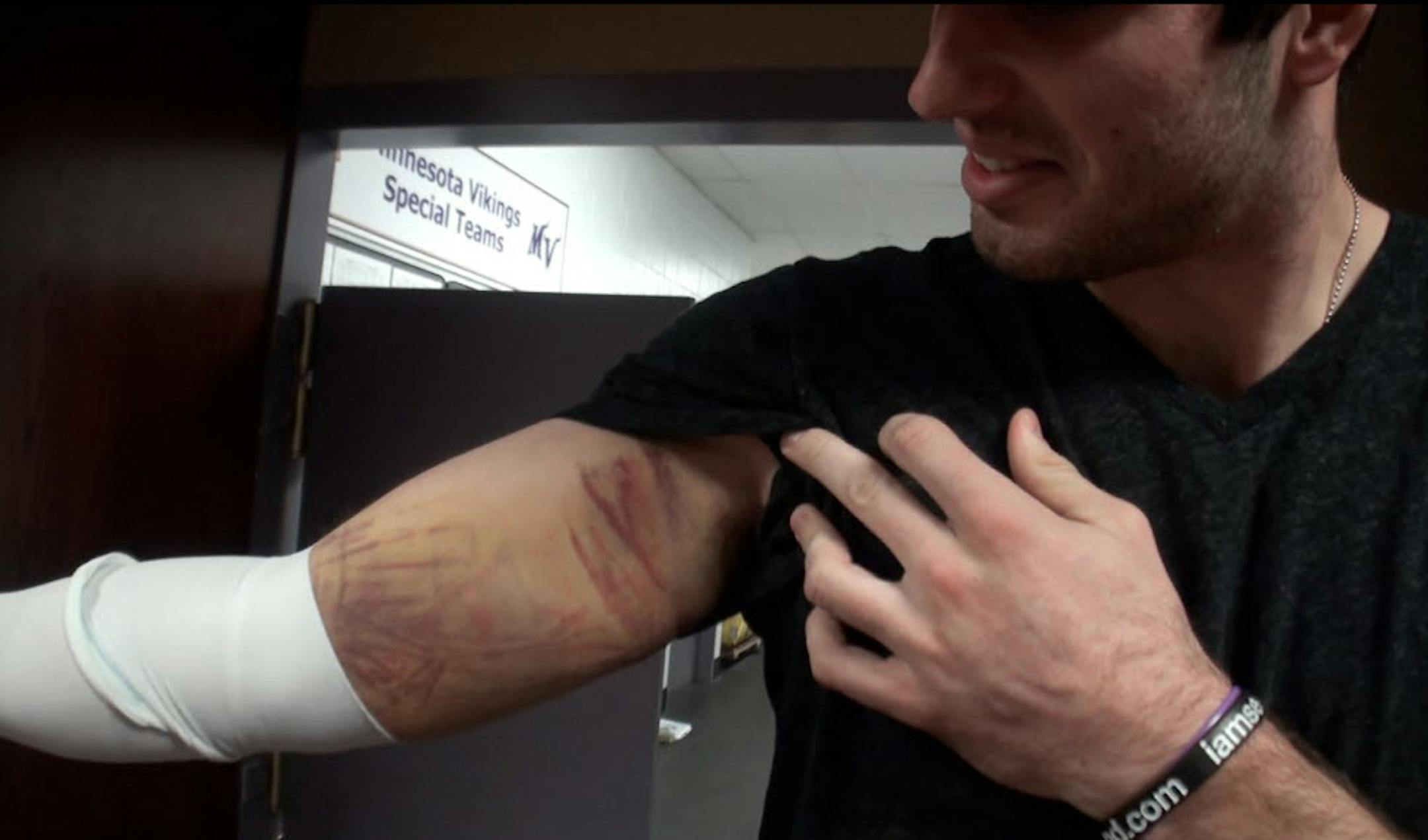 Injured Vikings quarterback Christian Ponder shows the bruise that kept him out of the playoff game against Green Bay.