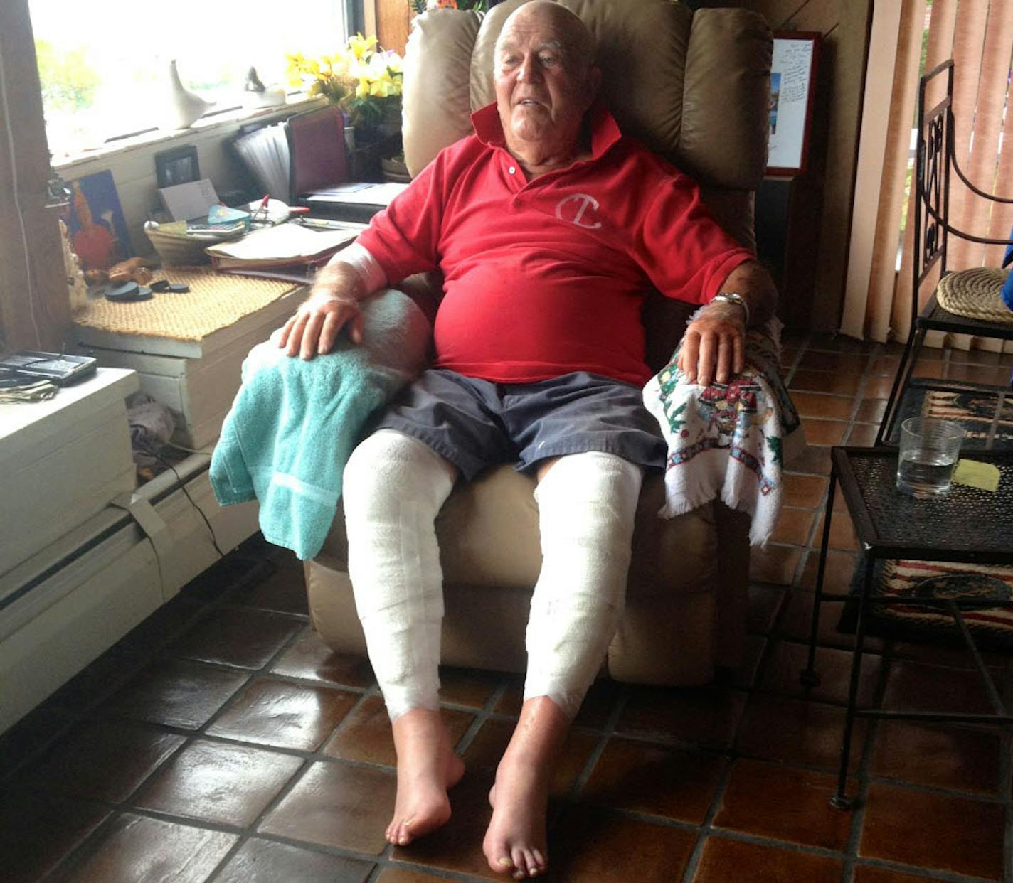 Philip Tuttle sits at his home in Harpswell, Maine recuperating from injuries to his legs.