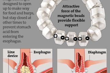 Controlling reflux with magnets