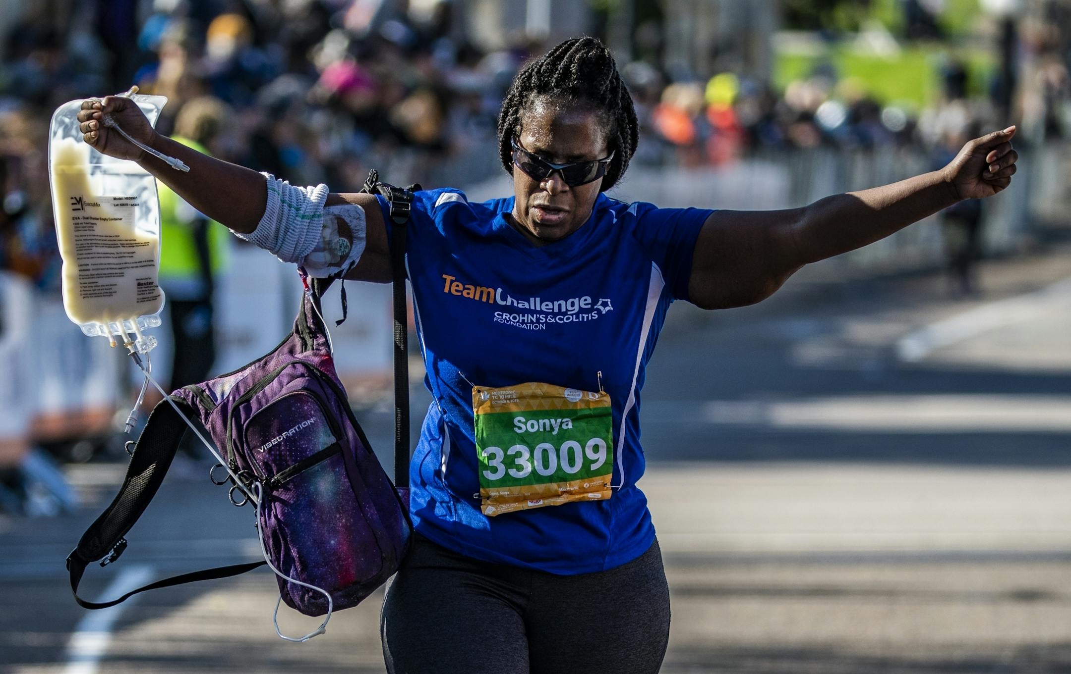 Sonya Goins who suffers from Crohn's Disease finished the 10 mile race and showed the nutrient bag attached to a feeding tube she had to rely on during the race.