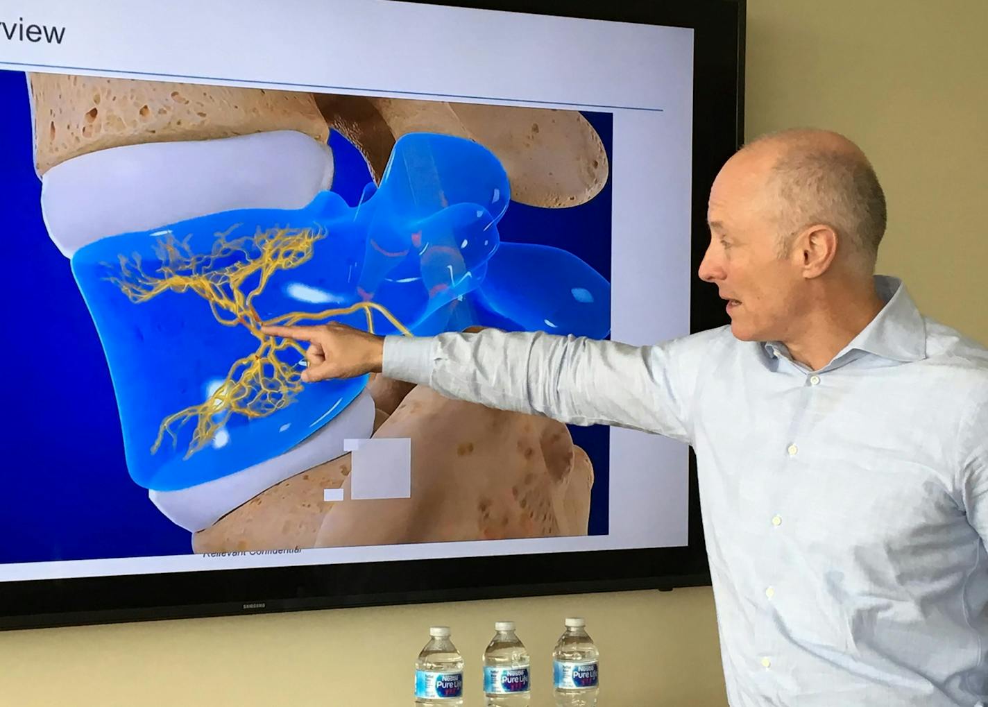 Relievant Medsystems CEO Kevin Hykes demonstrates where radiofrequency energy is applied to sever the basivertebral nerve, in yellow, during the &#xec;Intracept&#xee; procedure for certain forms of lower back pain. The company makes equipment and supplies for the procedure, including an electrode-tipped catheter inserted into lower-spine vertebrae to permanently zap the nerve.