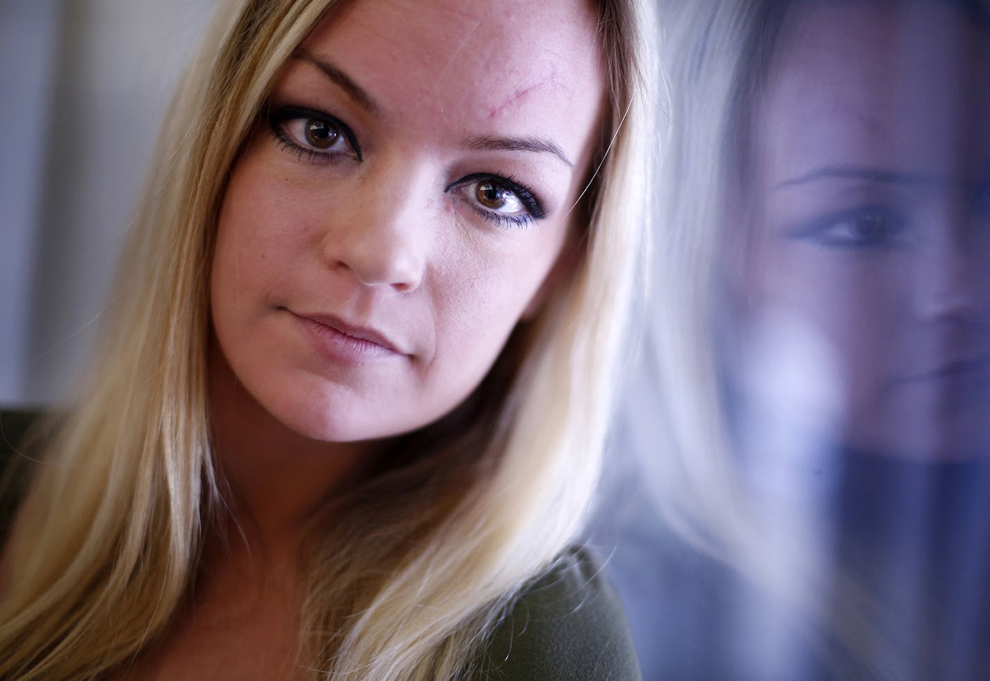 Hannah Linderholm poses for a portrait in Roseville on Tuesday, December 30, 2014. Linderholm shows the scar on her forehead from a limo accident that occurred in October 2014, ] LEILA NAVIDI leila.navidi@startribune.com / BACKGROUND INFORMATION: Hannah Linderholm was injured in a limo accident in October 2014, where she shattered her orbital bone, broke her nose and suffered a deep gash on her forehead. Linderholm has had two surgeries and is scheduled for another surgery soon. The insurer for