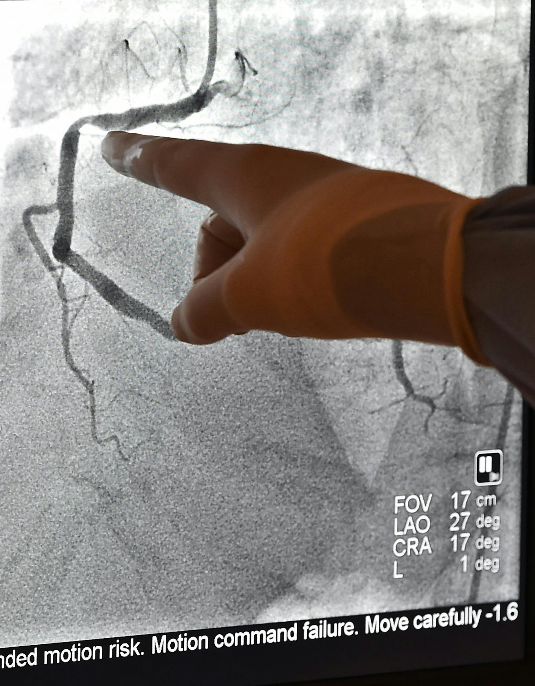 Kenneth Huber, an interventional cardiologist with Saint Luke's Mid America Heart Institute, points out the blockage in a patient's artery at Saint Luke's Mid America Heart Institute on November 25, 2015. Unnecessary angioplasties have declined in recent years. (Jill Toyoshiba/Kansas City Star/TNS) ORG XMIT: 1177325