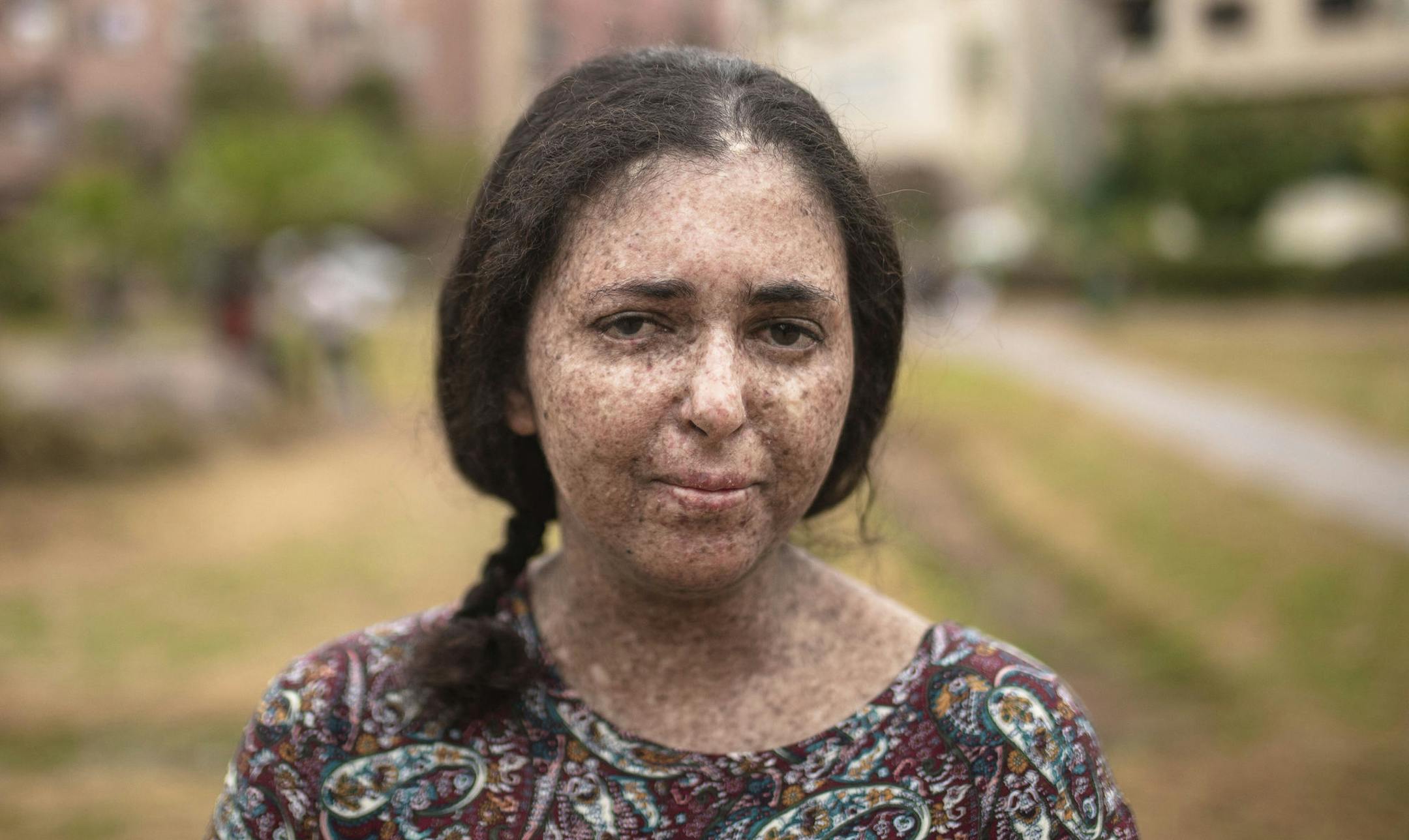 In this Tuesday, July 16, 2019 photo, Fatimazehra El Ghazaoui, 27, a woman affected by a rare disorder called xeroderma pigmentosum, or XP, poses for a portrait inside her home in Mohammedia, near Casablanca, Morocco. (AP Photo/Mosa'ab Elshamy)