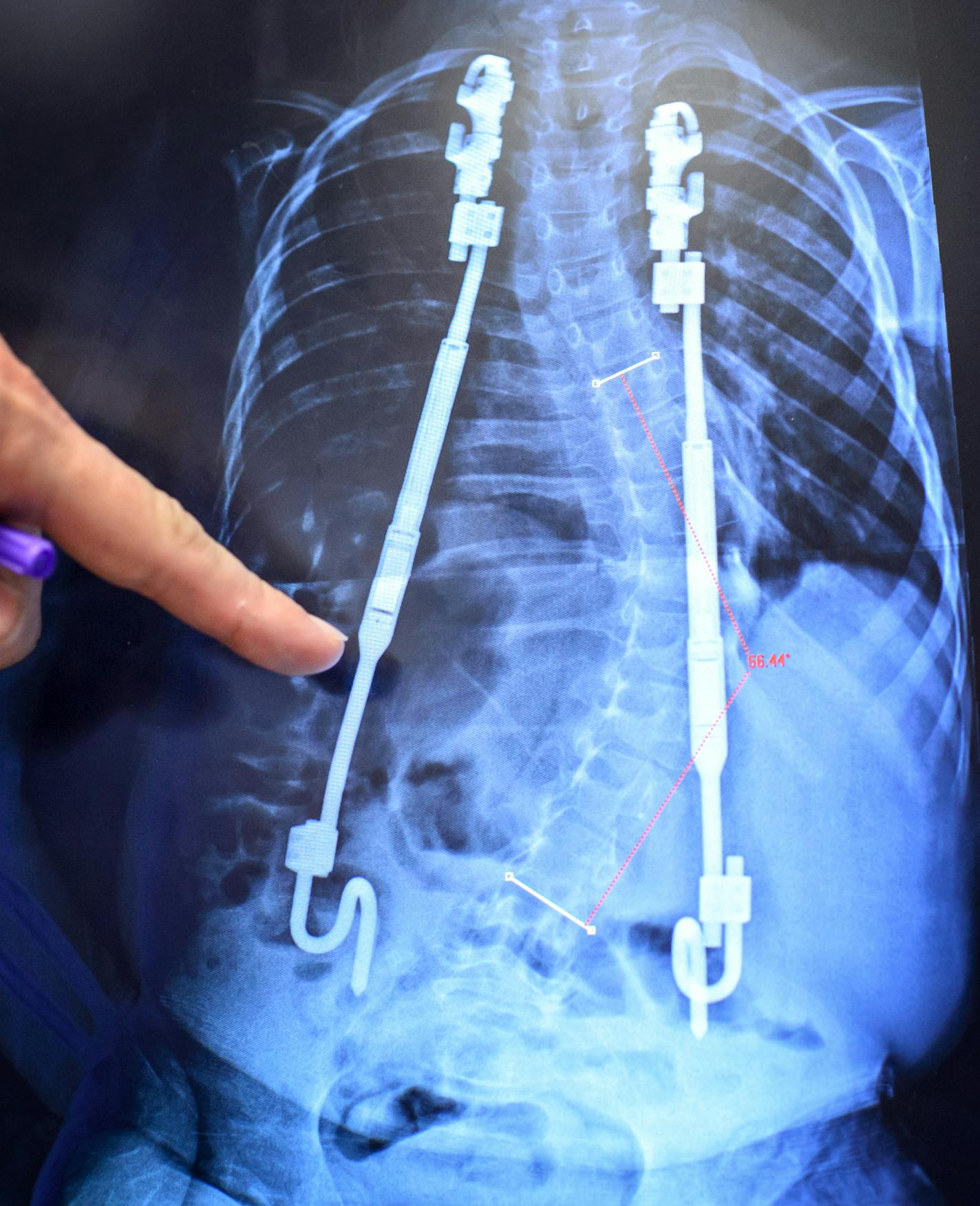 Magnetic rods for curved spines mean fewer surgeries for young patients