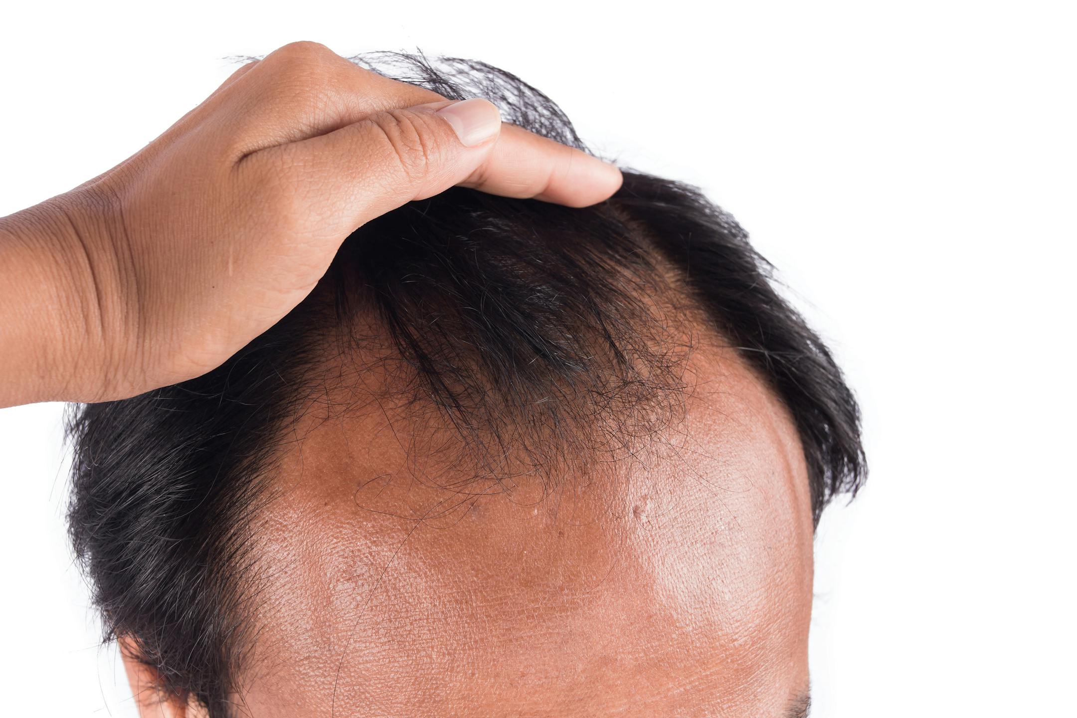 Hair loss is usually caused by a combination of heredity and aging. (Dreamstime/TNS)