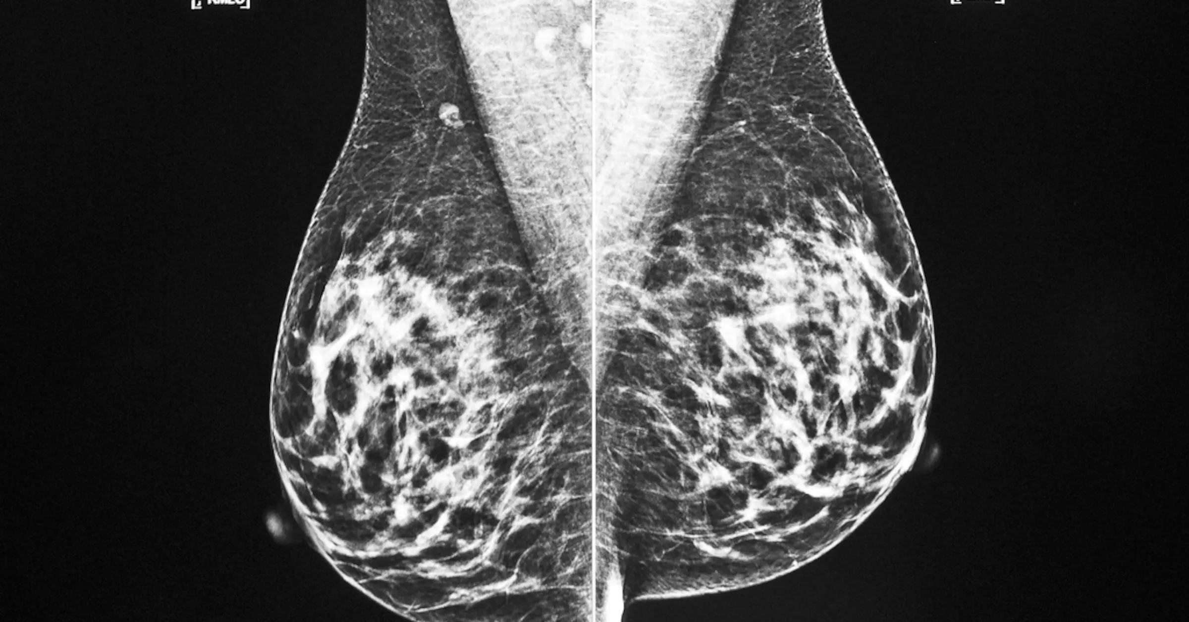 Brca2 Risks Mayo Clinic research reclassifies