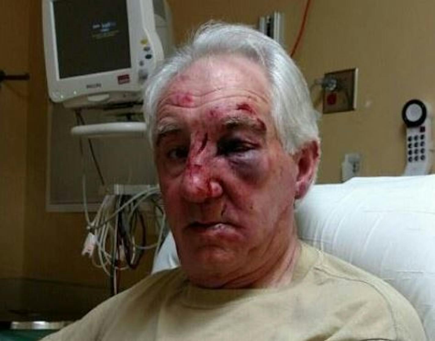 This victim of a reported road rage incident suffered multiple facial fractures and several lacerations requiring many stitches, the Sheriff's Office said.