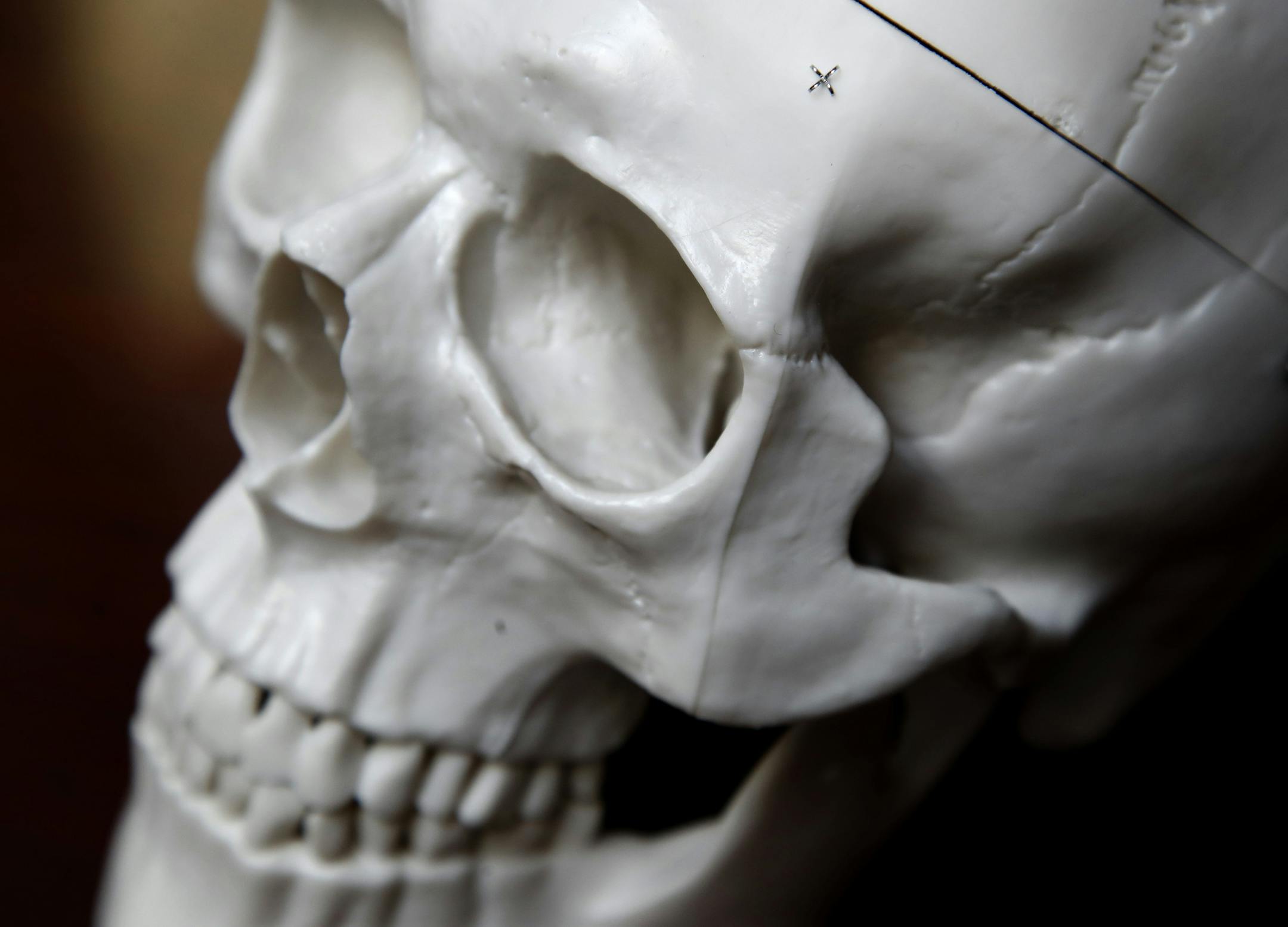 At the heart of Zift Medical’s Zift Lift procedure is a hook, which is smaller than a penny and implanted by an incision, that attaches brow tissue to the skin and bone. The start-up company has raised $3 million and is proceeding with a 20-person trial with residents from Minnesota and Wisconsin.