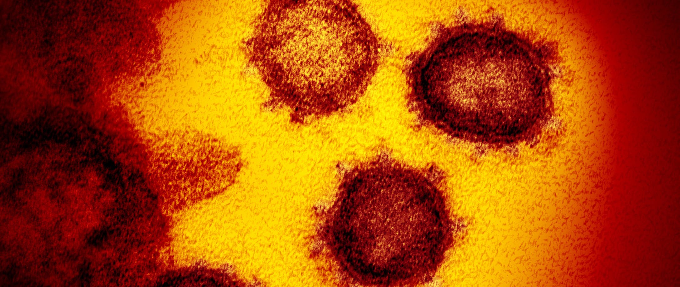 FILE - This undated electron microscope image made available by the U.S. National Institutes of Health in February 2020 shows the Novel Coronavirus SARS-CoV-2. Also known as 2019-nCoV, the virus causes COVID-19. The sample was isolated from a patient in the U.S. On Friday, Feb. 21, 2020, The Associated Press reported on a video circulating online incorrectly asserting that man in Wuhan, China, was sanitizing his apartment with alcohol when the air conditioner came on and caused an explosion and