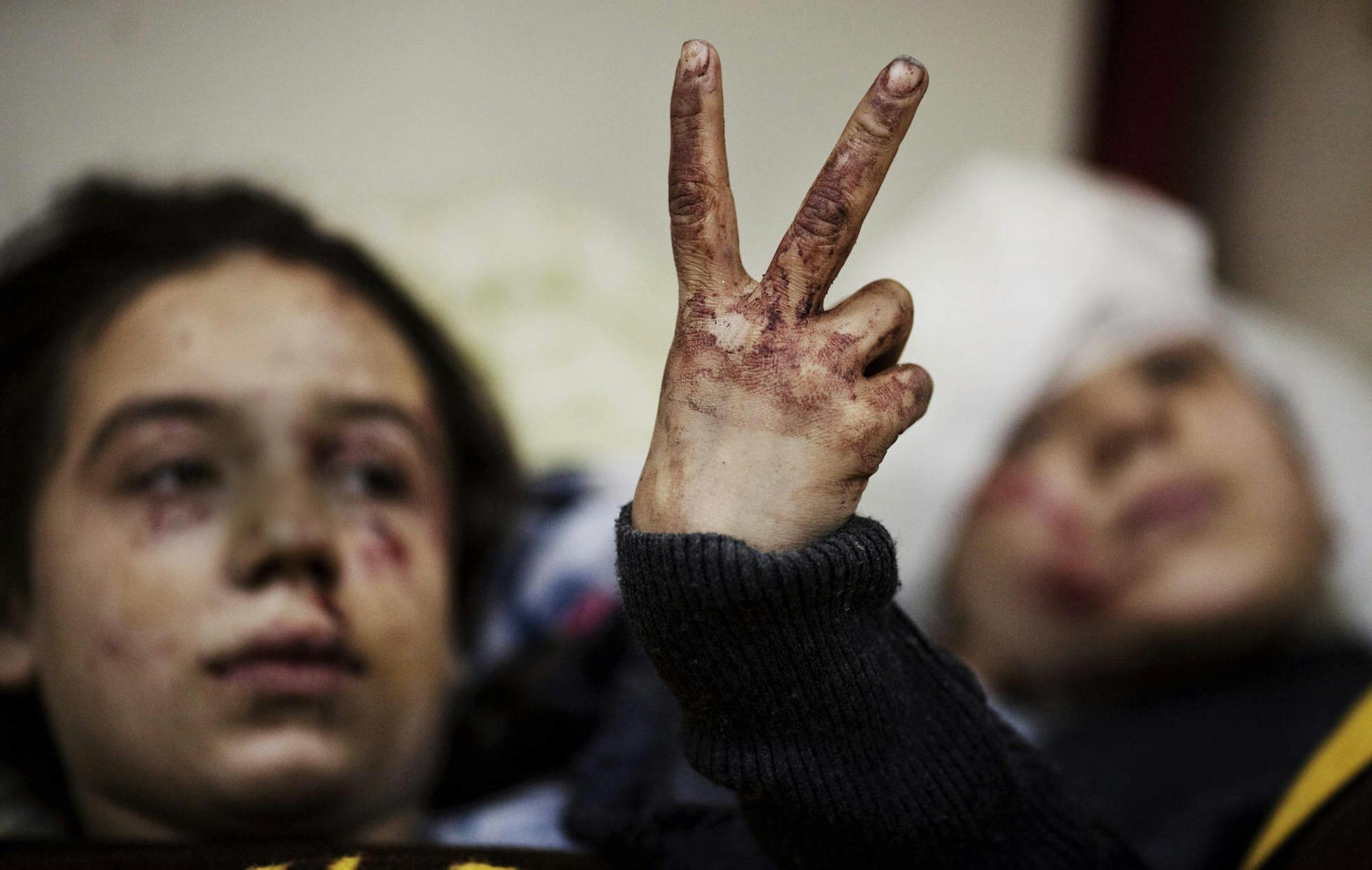 FILE - In this Saturday, March 10, 2012 file photo, Hana, 12, flashes the victory sign next to her sister Eva, 13, as they recover from severe injuries after the Syrian Army shelled their house in Idlib, north Syria. Their father and two siblings were killed after their home was shelled. Wounded people, including children and women, crowded into the clinic in bloodstained clothes. Many had clearly been struck by snipers, who shot them through the legs and arms. (AP Photo/Rodrigo Abd, File)