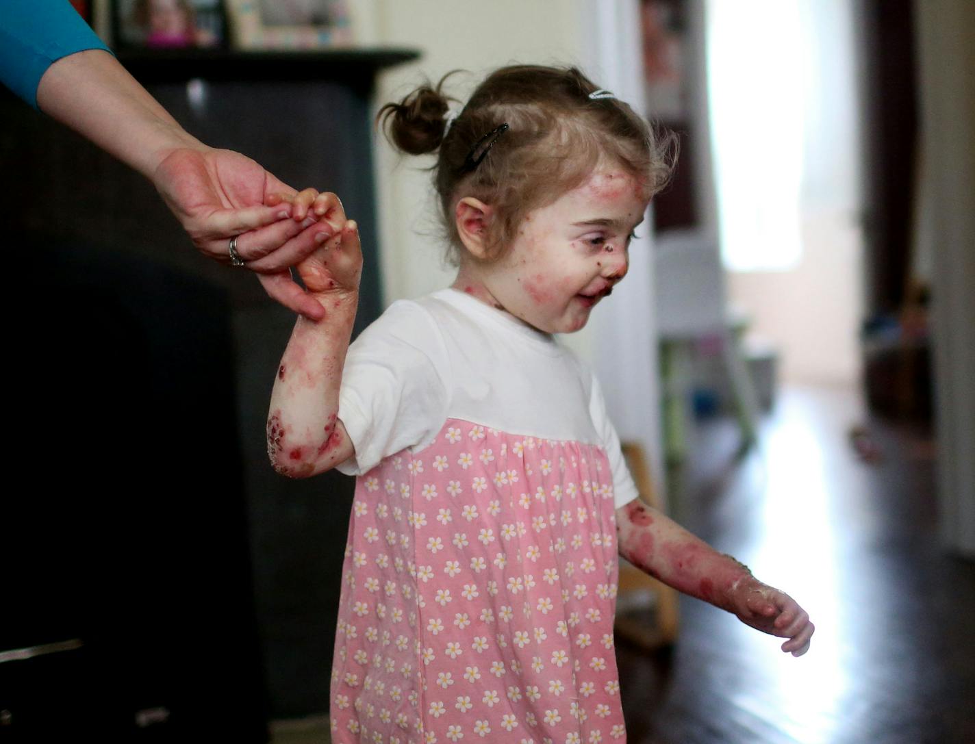 Little Elisa McCann is enrolled and ready to become one of the first pain patients admitted to Minnesota's medical marijuana program. Elisa, now 3, suffers from a horrific genetic condition called epidermolysis bullosa that causes her skin to blister and tear at the slightest contact. She was photographed at home with her mom Gabriella McCann Wednesday, July 27, 2016, in St. Paul, MN. ](DAVID JOLES/STARTRIBUNE)djoles@startribune On Monday, Minnesota's medical marijuana clinics will open their do