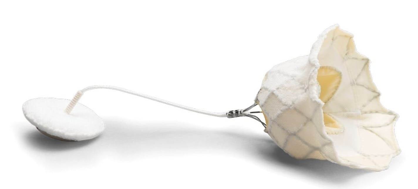 The Tendyne Transcatheter Mitral Valve Inplant is a wire-and-mesh device invented in Roseville that has become the first transcatheter valve to get European approval for replacing the heart&#x2019;s mitral valve.