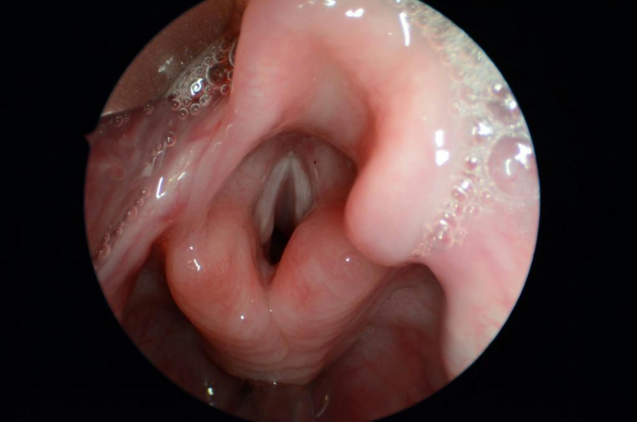 In this photo provided by J. Scott McMurray Md., Associated Professor, University of Wisconsin School of Medicine and Public Health, taken Oct. 14, 2011, shows a normal larynx and vocal folds, center, during surgery in Madison, Wis. Our voices are the main way we communicate, one we mostly take for granted until something goes wrong. Now researchers have grown human vocal cords in the laboratory, a step toward one day helping to restore a voice to people who have lost theirs to disease or injury