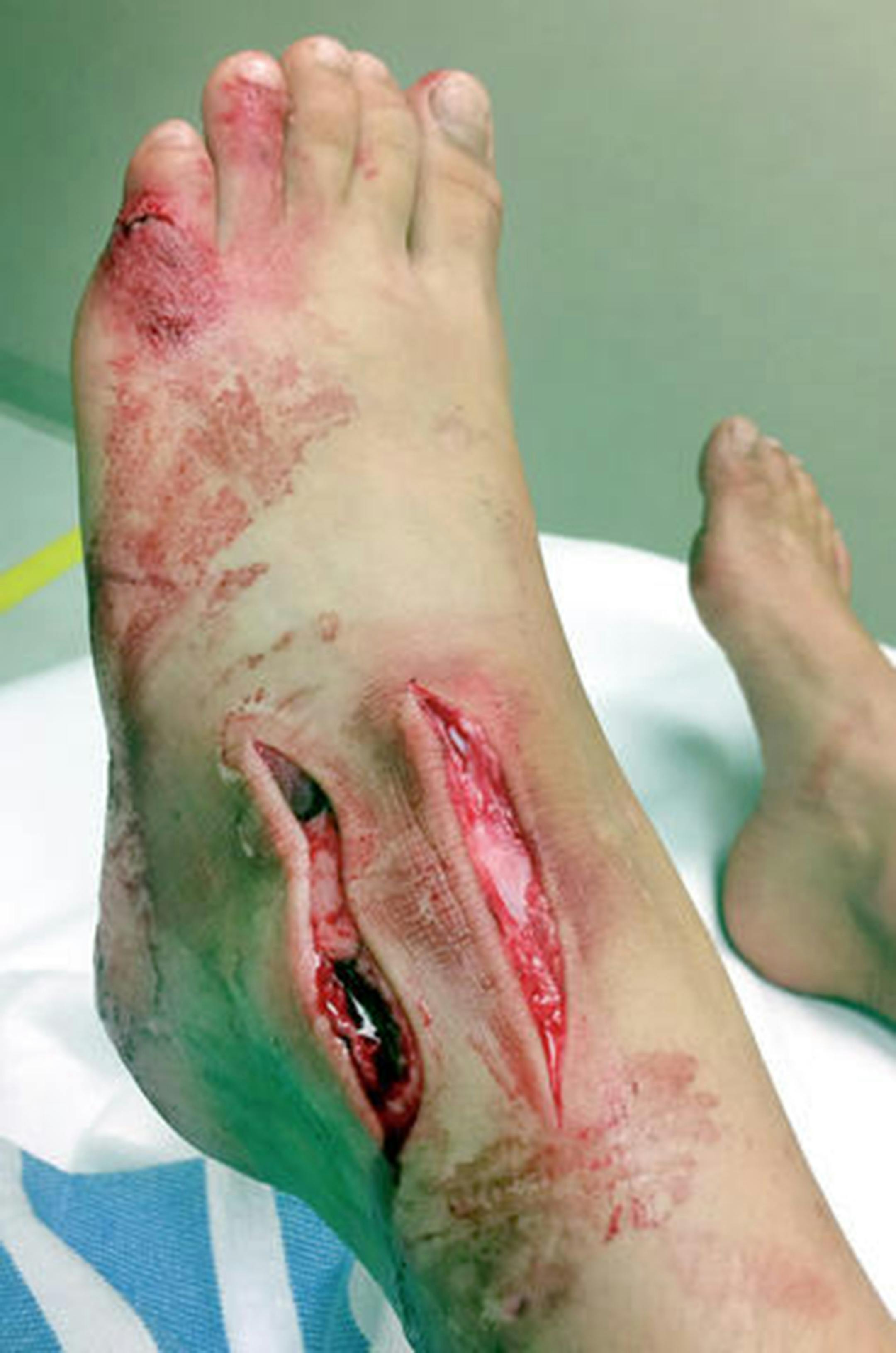 Eleven-year-old Maren Kesselhon's foot was lacerated, possibly by a large fish, last week on Island Lake north of Duluth. Her foot and leg were cut in 25 places, said her father, Ryan Kesselhon of Duluth. Nine cuts required stitches at St. Mary's Essentia Health in Duluth, and one of her tendons needed repair, Kesselhon said.