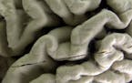 FILE - This Oct. 7, 2003 file photo shows a section of a human brain with Alzheimer's disease on display at the Museum of Neuroanatomy at the Universi