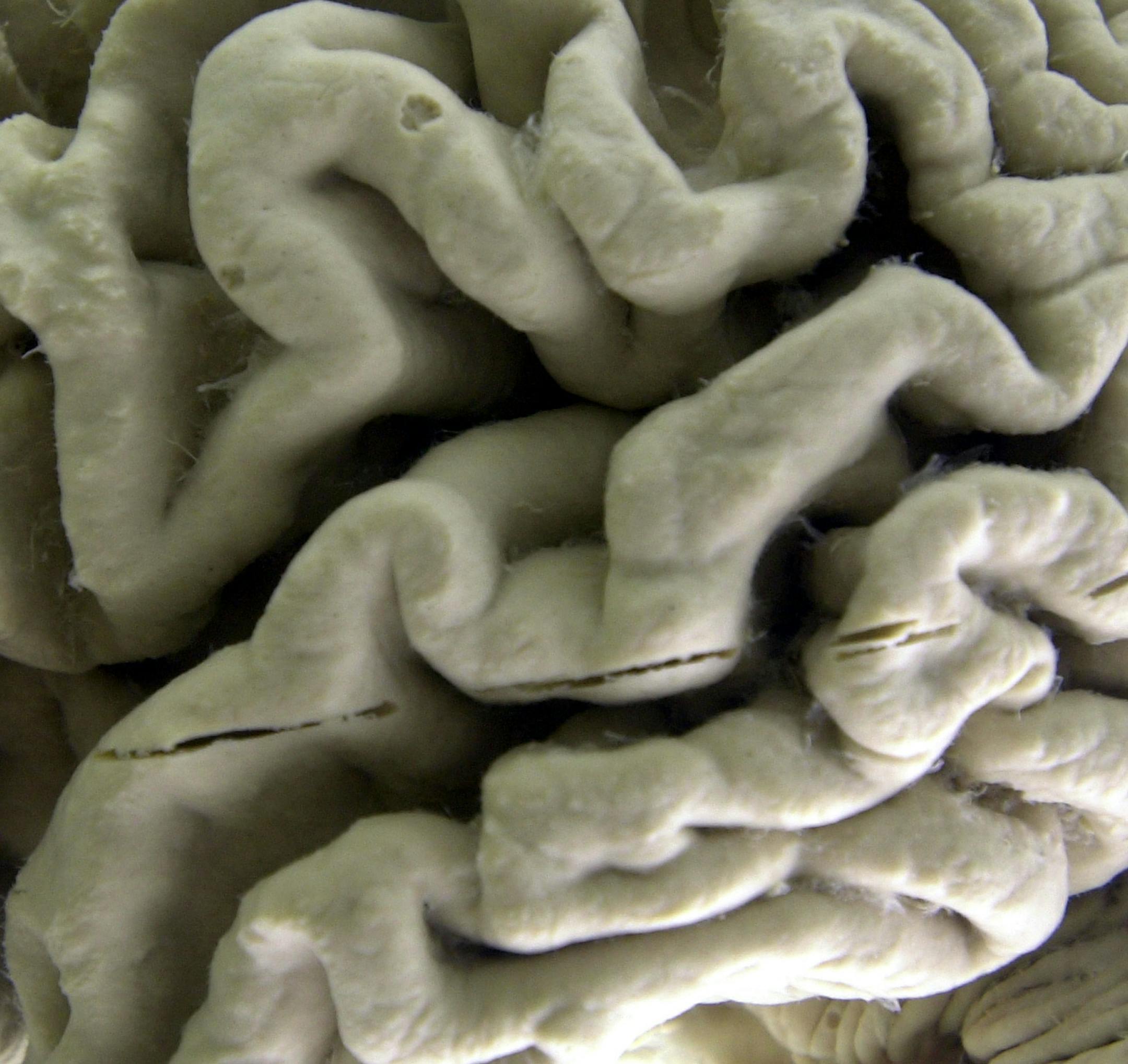FILE - This Oct. 7, 2003 file photo shows a section of a human brain with Alzheimer's disease on display at the Museum of Neuroanatomy at the University at Buffalo, in Buffalo, N.Y. On Wednesday, July 25, 2018, two drug makers said an experimental therapy slowed mental decline by 30 percent in patients who got the highest dose in a mid-stage study, and it removed much of the sticky plaque gumming up their brains. The drug, called BAN2401, is from Eisai and Biogen. (AP Photo/David Duprey)