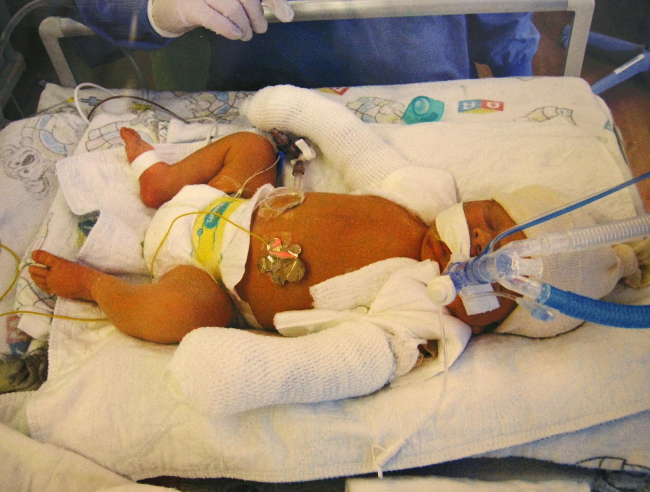 Baby Maverick after the accident being treated at Hennepin County Medical Center.