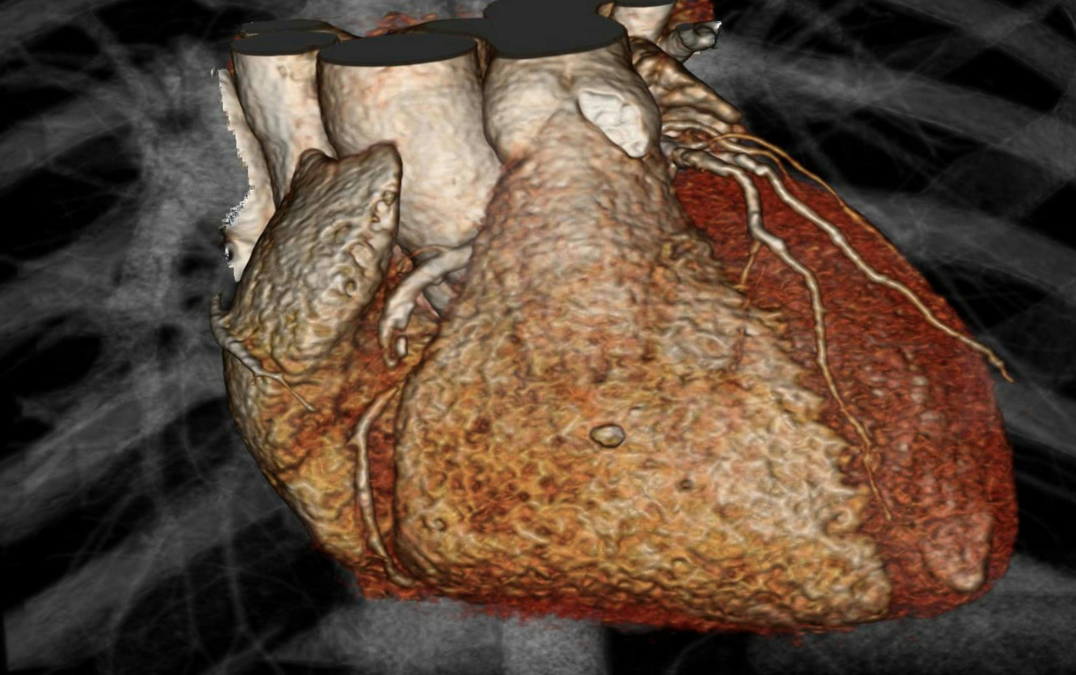 This image provided by Drs. Udo Hoffmann and Michael Lu, of Massachusetts General Hospital, shows a 3-D fast CT scan computer rendering of a heart in a patient who has stable chest pain. According to a federal study released Saturday, March 14, 2015, people checked with a heart CT scan after seeing a doctor for chest pain have no less risk of heart attack, dying or being hospitalized months later than those who take a simple treadmill test or other older exam. (AP Photo/Massachusetts General Hos