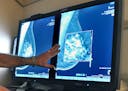 FILE - In this Tuesday, July 31, 2012, file photo, a radiologist compares an image from earlier, 2-D technology mammogram to the new 3-D Digital Breas