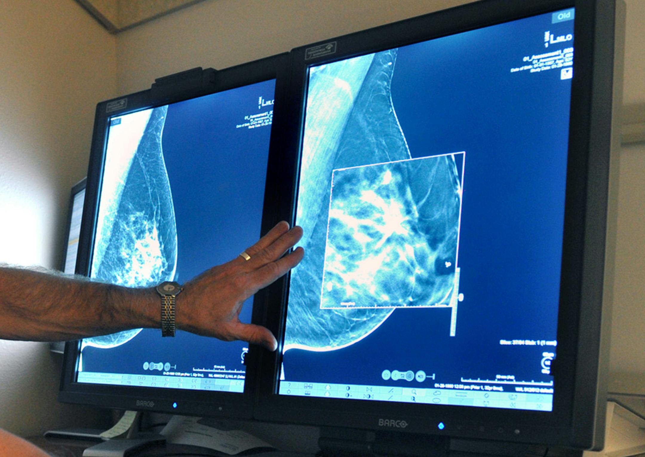 FILE - In this Tuesday, July 31, 2012, file photo, a radiologist compares an image from earlier, 2-D technology mammogram to the new 3-D Digital Breast Tomosynthesis mammography in Wichita Falls, Texas. The technology can detect much smaller cancers earlier. In guidelines published Tuesday, Oct. 20, 2015, the American Cancer Society revised its advice on who should get mammograms and when, recommending annual screenings for women at age 45 instead of 40 and switching to every other year at age 5