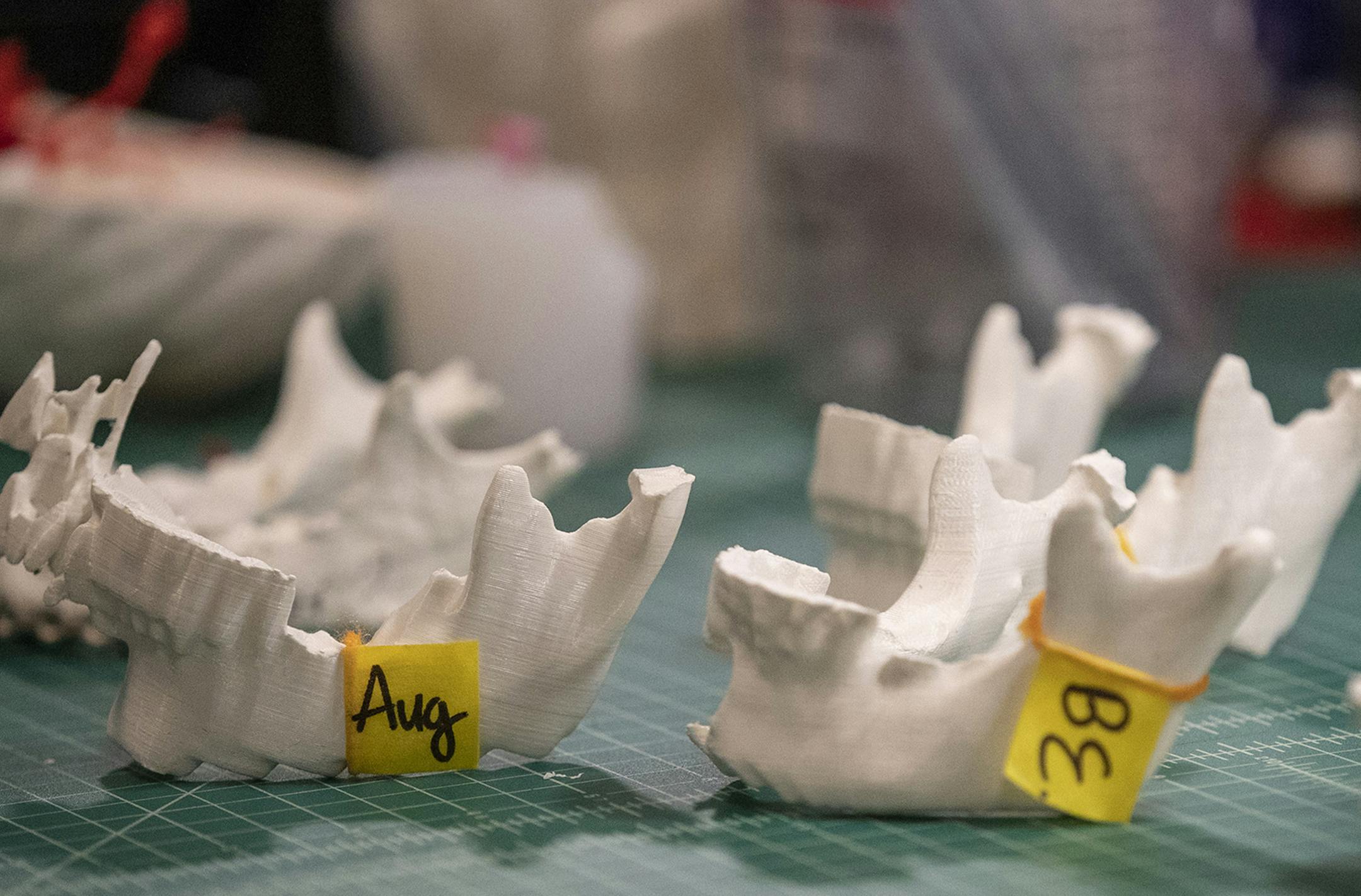 Using a 3D printer, Jefferson University researchers modeled the jawbones of Haitian patients whose faces were disfigured by tumors. Surgeons traveled to Haiti in January to perform the surgeries. (Heather Khalifa/Philadelphia Inquirer/TNS)