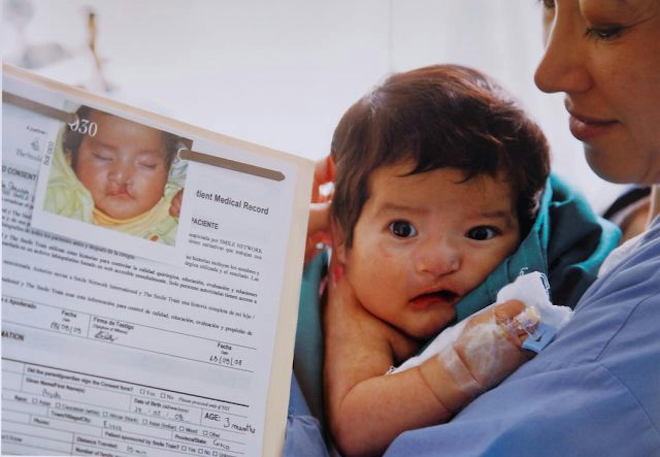 A before photo, left, shows how the procedure to correct a cleft palate made a big difference for a Peruvian child.