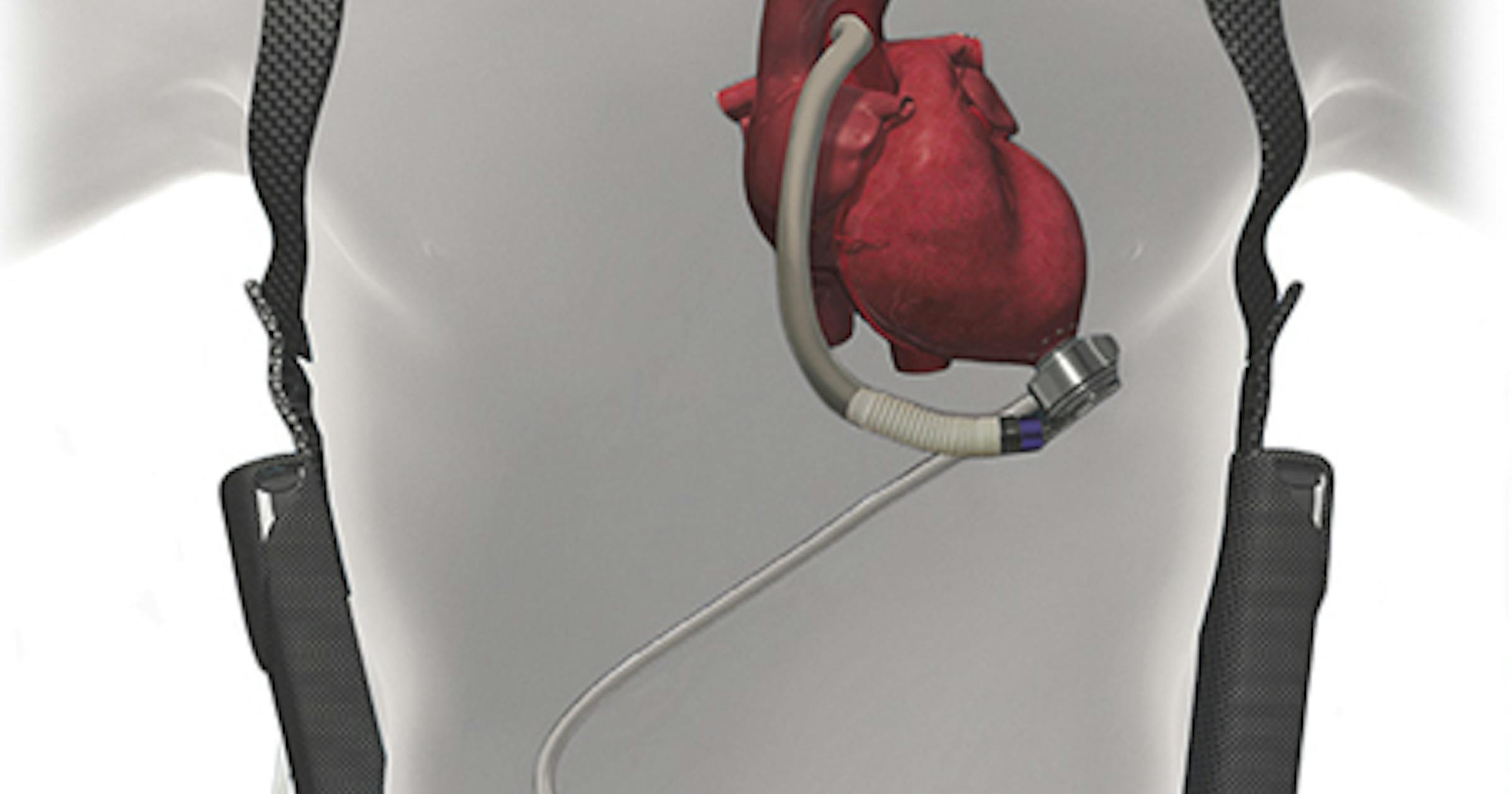 Abbott s HeartMate 3 Pump Shows Improved Results In Clinical Trial abbott-s-heartmate-3-pump-shows-improved-results-in-clinical-trial
