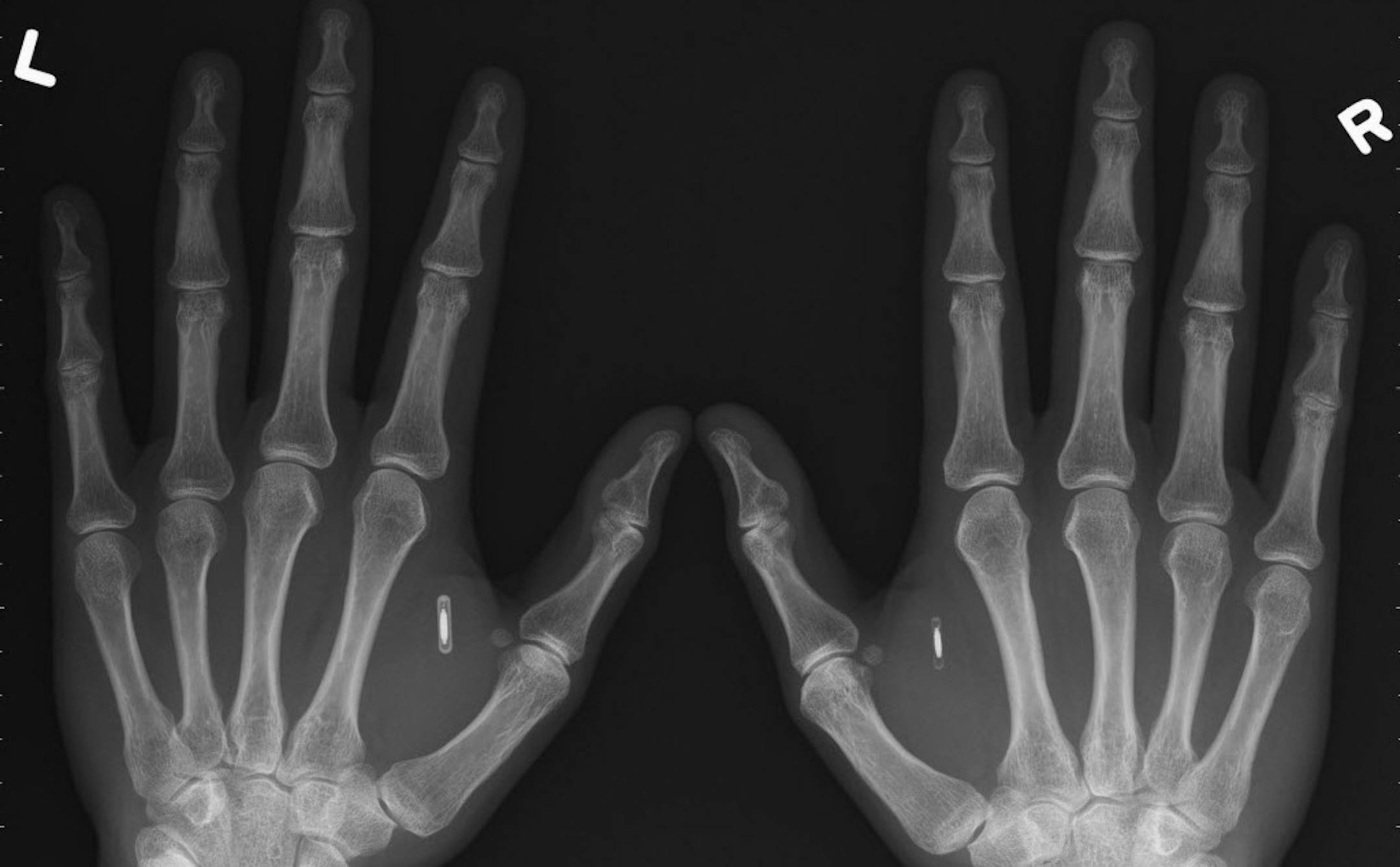 This X-ray depicts the hands of Amal Graafstra, founder of Dangerous Things. He has had two radio frequency identifier inplants in his hands which he uses to unlock his car, computer and door to his Seattle home. (Courtesy of Amal Graafstra/MCT) ORG XMIT: 1147011