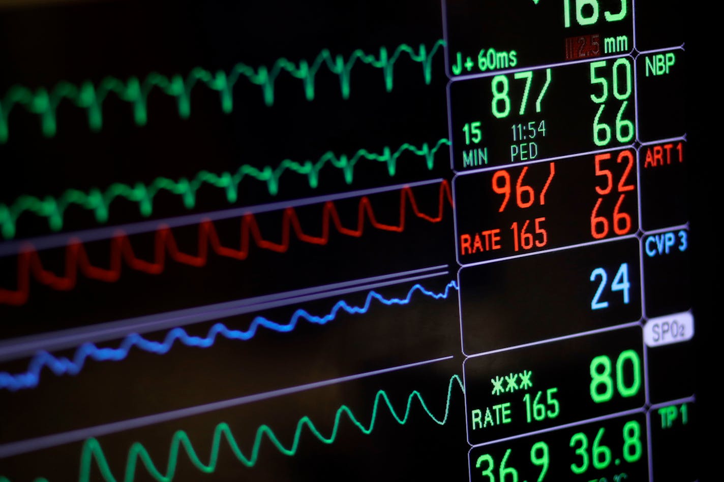 In this Nov. 28, 2016, file photo, a screen displays a patient's vital signs during open heart surgery at the University of Maryland Medical Center in Baltimore. (AP Photo/Patrick Semansky, File)