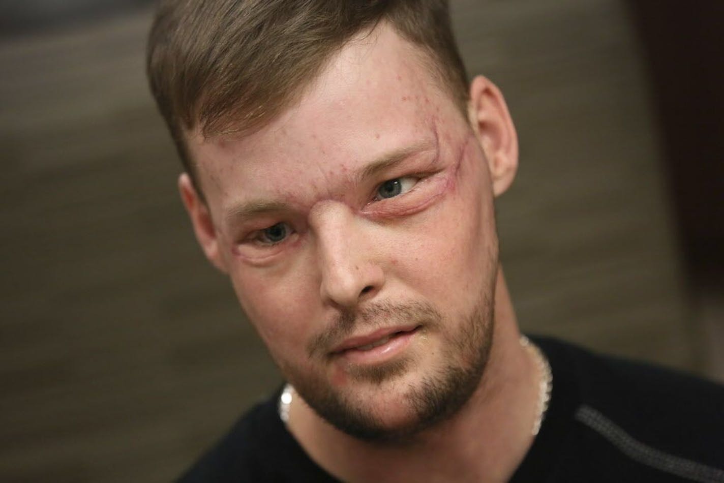 In this Jan. 24, 2017, photo, face transplant recipient Andy Sandness attends a speech therapy appointment at Mayo Clinic in Rochester, Minn. He wasn't allowed to see himself immediately after the surgery. His room mirror and cell phone were removed. When he finally did see his face after three weeks, he was overwhelmed. "Once you lose something that you've had forever, you know what it's like not to have it. ... And once you get a second chance to have it back, you never forget it." Just having