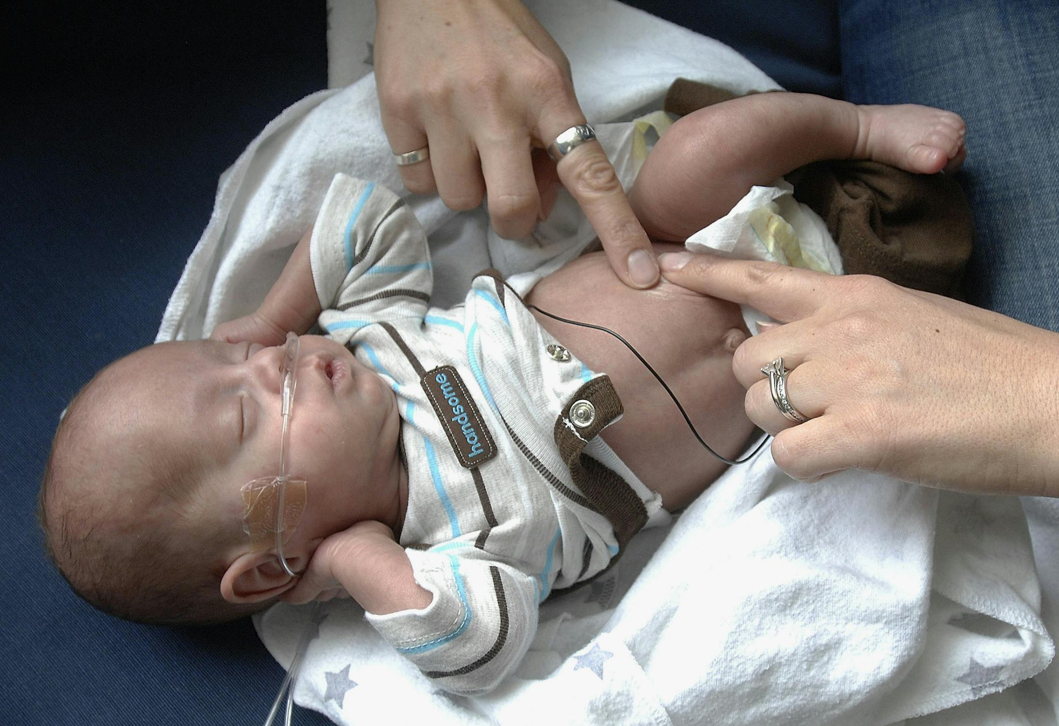 ADVANCE FOR USE SUNDAY, AUG. 31 AND THEREAFTER - In this Aug. 5, 2014 photo, Nicole Nyberg of Bloomington, Ill., massages the scars on the skin of her son, William, who was born prematurely at 23 weeks and was 1 pound 6 ounces on April 28th. William came home on July 28, three weeks before his Aug. 21 due date. (AP Photo/The Pantagraph, Lori Ann Cook-Neisler) ORG XMIT: MIN2014082723445970